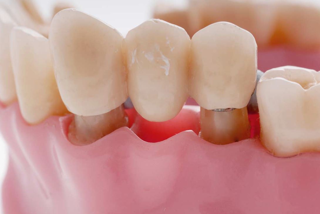 Step-by-step Guide To Repairing A Dental Bridge